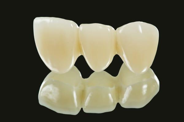 Porcelain Layered Zirconia Bridge