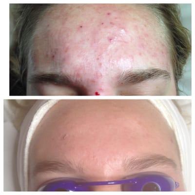 before and after 3 treatments