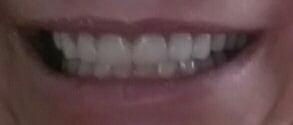 4 days after major dental restoration surgery!