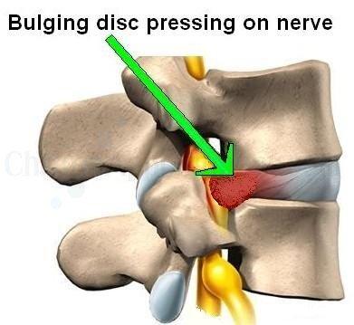 Spinal Decompression Therapy