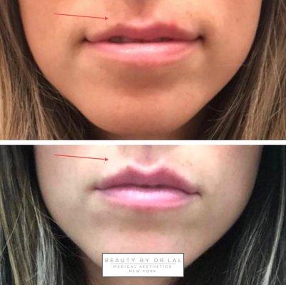 Our beautiful patient received 1 Syringe of Vollure to bring balance and slight volume to her lips.