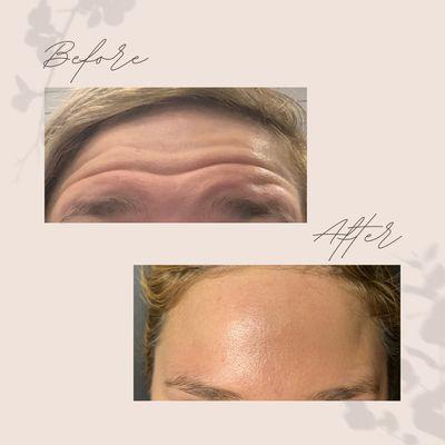 Treated with neuromodulators (wrinkle relaxers)