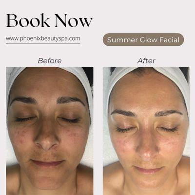 Amazing result from only one facial treatment! Book now and enjoy this advanced red-carpet facial yourself! www.phoenixbeautyspa.com