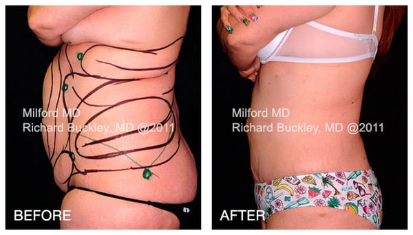 Before and After Laser Liposuction Abdomen & Waist - MilfordMD