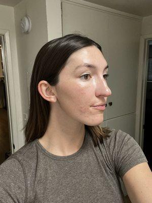 A few days post facial