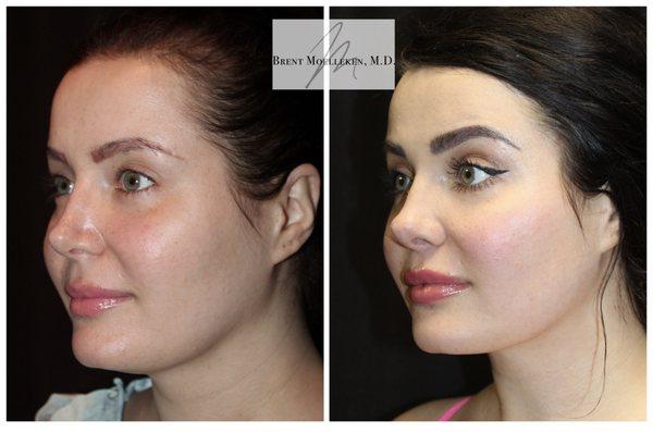 Reconstructive Fat transfer to lips and nasolabial folds, pinched nose correction, lip lift, neck lipo & necklace, hairline reshaping