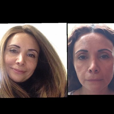 Before and After Botox and Juvederm Photos