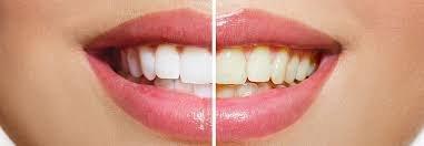 Teeth Whitening