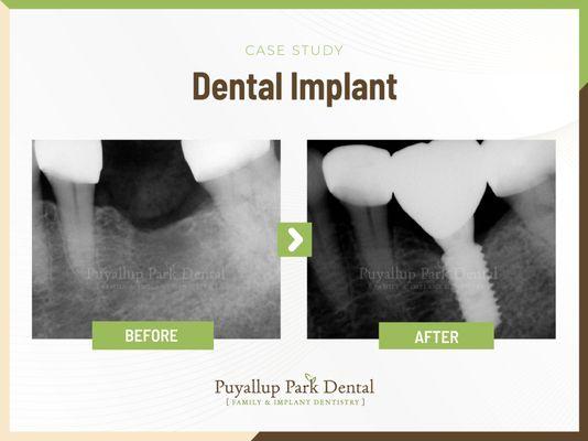 Puyallup Park Dental Family Emergency Implants Braces Invisalign | 13909 Meridian E suite a-1, Puyallup, WA 98373 | Call: (253) 435-0333