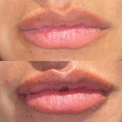 Lip filler before and after