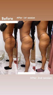 LIPO CAVITATION