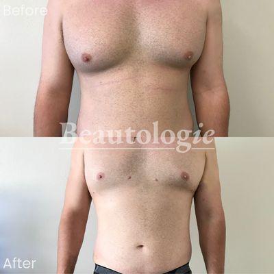 Gynecomastia Reduction Before and After