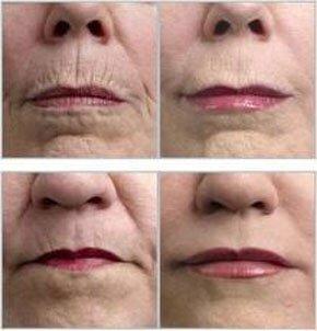 Stem-Cell Treatments for controlling wrinkles.