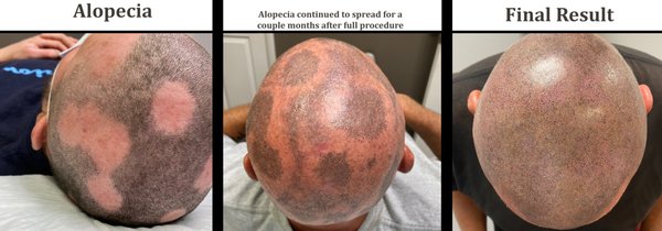 South Shore Scalp Micropigmentation and Microblading