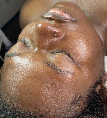 Chemical peel after glow