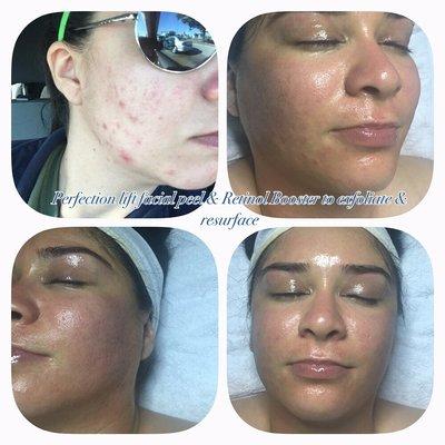 Acne treatment facials