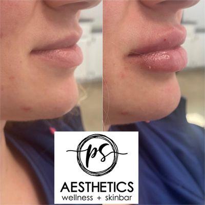 Lip fillers in Edmond