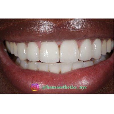 Hans Aesthetics Dental lab Aesthetics Porcelain veneers, cosmetic dentistry Aesthetic dental lab nyc dental lab feldspathic veneers