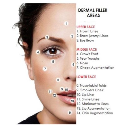 This photo is a great guide to help you visualize the areas where fillers can be added .