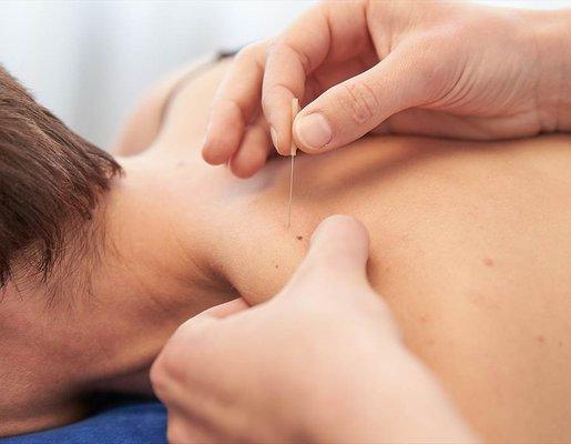 Trigger Point Dry Needling