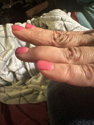 Tumor nails