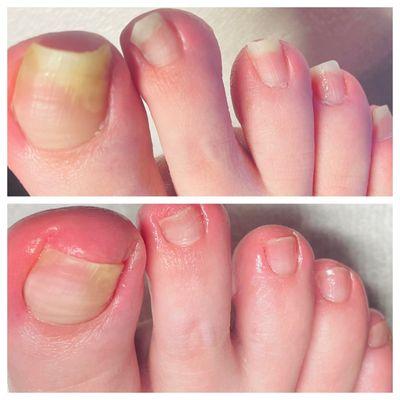 Toenail transformation. Vana has advanced education in pedicures for issues of the toe nails