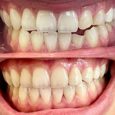 2 veneers - which ones are they? Most difficult thing in dentistry is to do single veneers, think we nailed it?