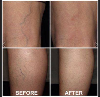 Sclerotherapy for spider and varicose veins