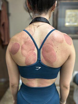 Cupping releases painful trigger points, improves blood and lymph circulation, relieves pain, promotes mobility and range of motion.