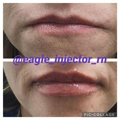 Look at the gorgeous lips! This look was achieved with 1/2 syringe of Kysse.