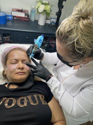 Plasma Pen being applied to the forehead