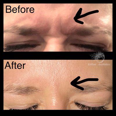 Treated with neuromodulators (wrinkle relaxers)