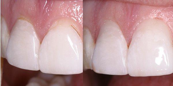 We can repair existing crowns rather than replacing, as long as the structure is sound.