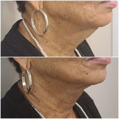 Facial threads and 2 syringes of jawline filler.