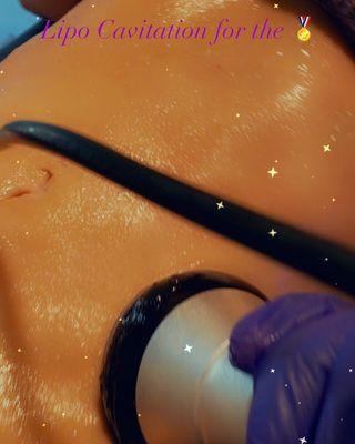 Lipo Cavitation. A noninvasive form of lipo that uses ultrasonic waves break up and melt fat cells.