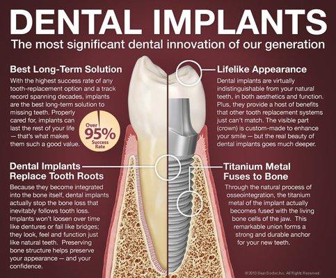 Dental Implants are one of our specialties! Ask about implant promotions.