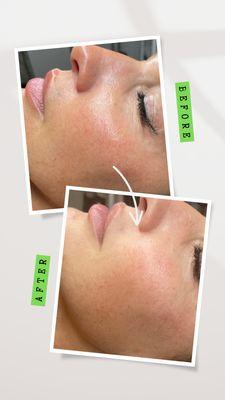 Procell Treatment - after session