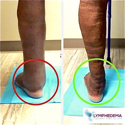 Lymphedema Clinic Houston | Lymphedema Therapy Patient Results Before & After