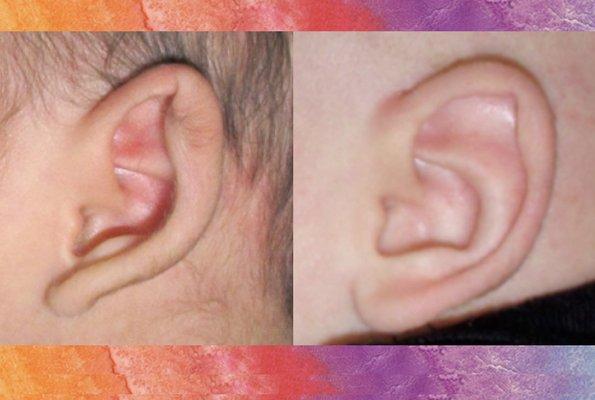 Infant Ear Molding (Ear Well) Before & After - non surgical treatment