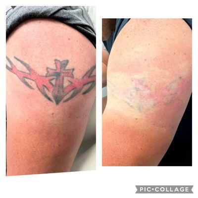 Pico-laser Tattoo removal-6 sessions, almost erased!