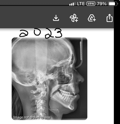 Bones In my skull moved so badly, I'm not a candidate for braces