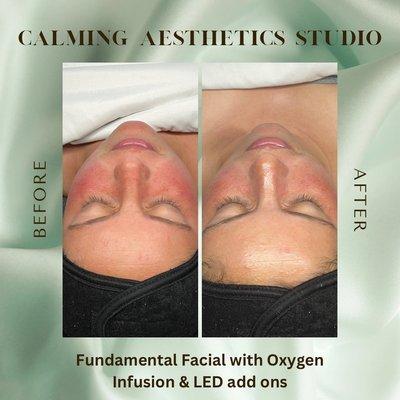 Before and after Fundamental Facial with Oxygen Infusion & LED add ons