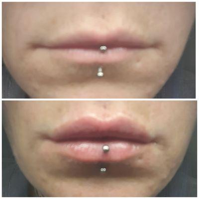 Hyaluron Pen Lip Fillers 
0.5ml on top to pucker up that top Lip! Love to see my clients happy with their results!