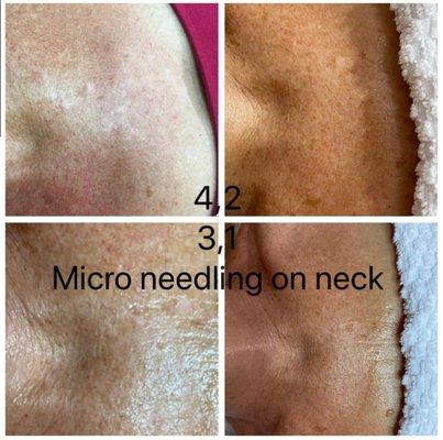 Microneedling on neck