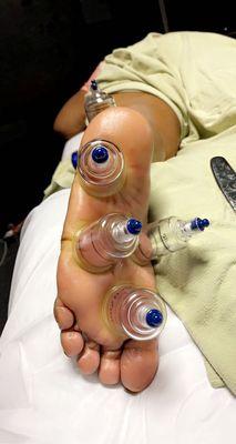 Treating plantar fasciitis. Scraping an cupping the feet will help pull those toxins and stress off the feet .