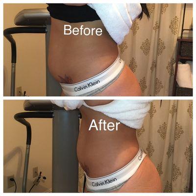 Before and after only one 45 minute Cavi-Lipo treatment!