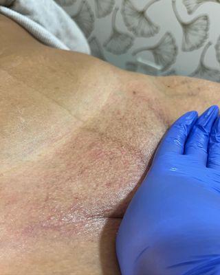 Brazilian sugaring