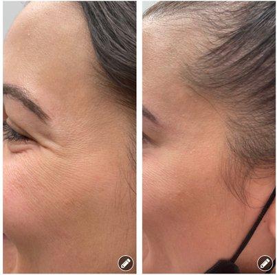 Botox Before vs. After | #ReviveFaceBodySkin