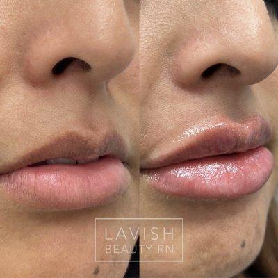 Restylane Kysse lip filler before & after