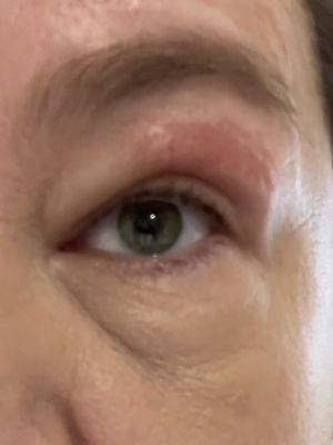 The day after my wax. Eye is swollen and skin was basically burned off. Cheap wax!